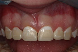 Close-up image of front teeth of an adolescent after a restoration of visible chipped area.
