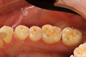 Close-up image of teeth with severely worn area.