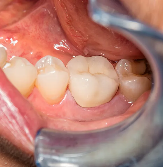 Zirconia crowns placed by Dr. Boris Kaltchev, offering a natural look and optimal functionality.