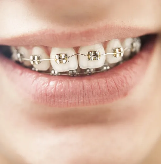 Close-up of a person smiling with traditional metal braces on their teeth.