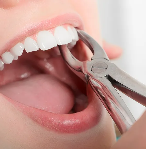 Close-up of a dental extraction procedure using forceps on a patient’s tooth.