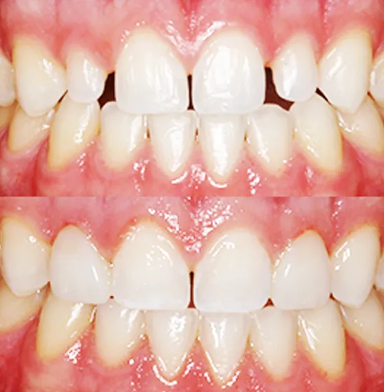 Before and after images showing improved alignment and aesthetics through direct dental bonding.