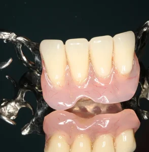 Close-up of a dental partial denture with metal clasps and artificial teeth on a reflective surface.