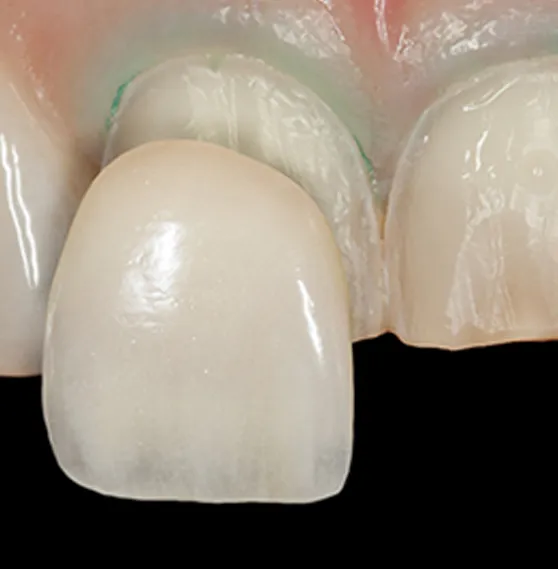 Close-up view of a porcelain veneer on a front tooth.
