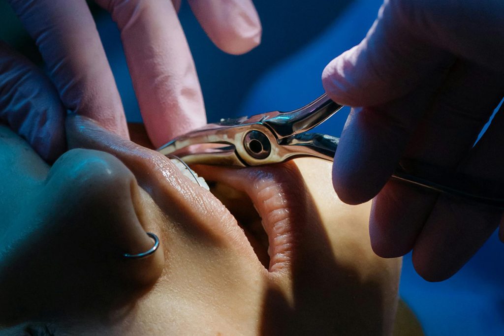 A dentist extracting a tooth.