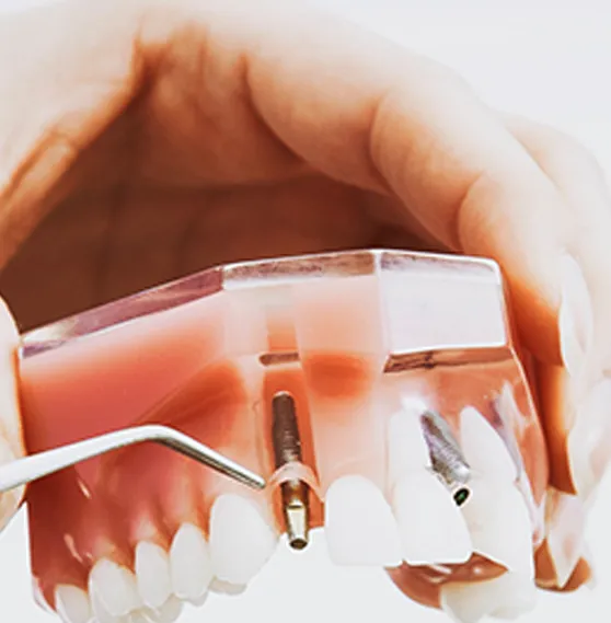 Demonstration of a dental implant model with tools.