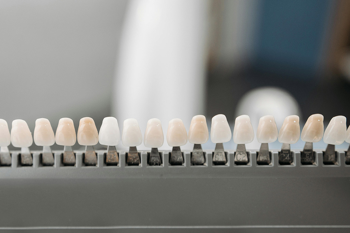A line up of porcelain veneers.