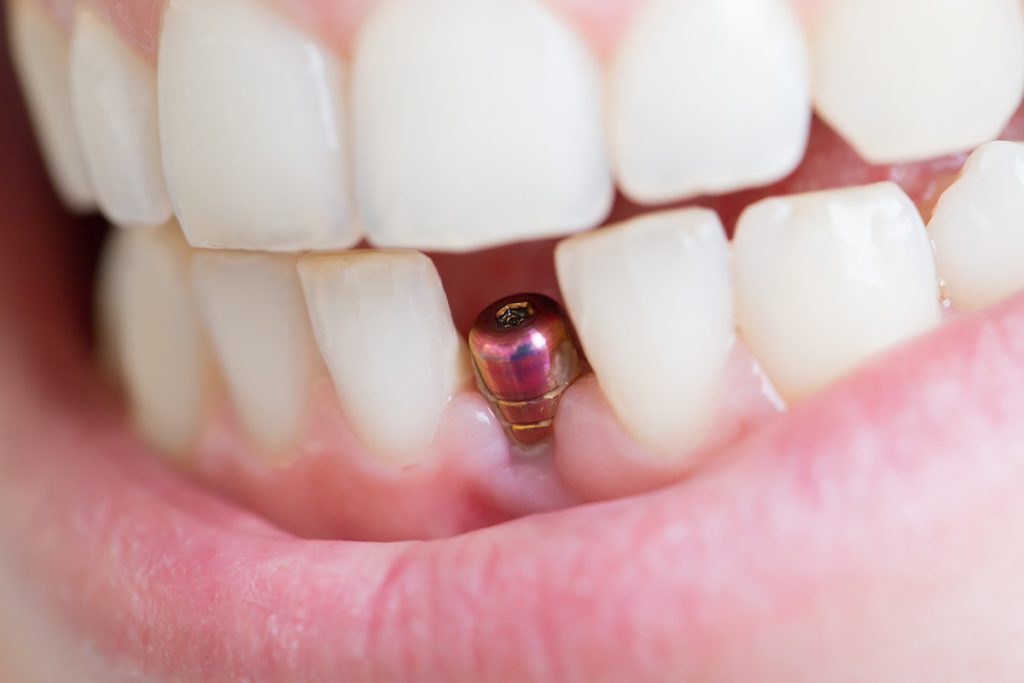 A close-up of metal implant in gums.