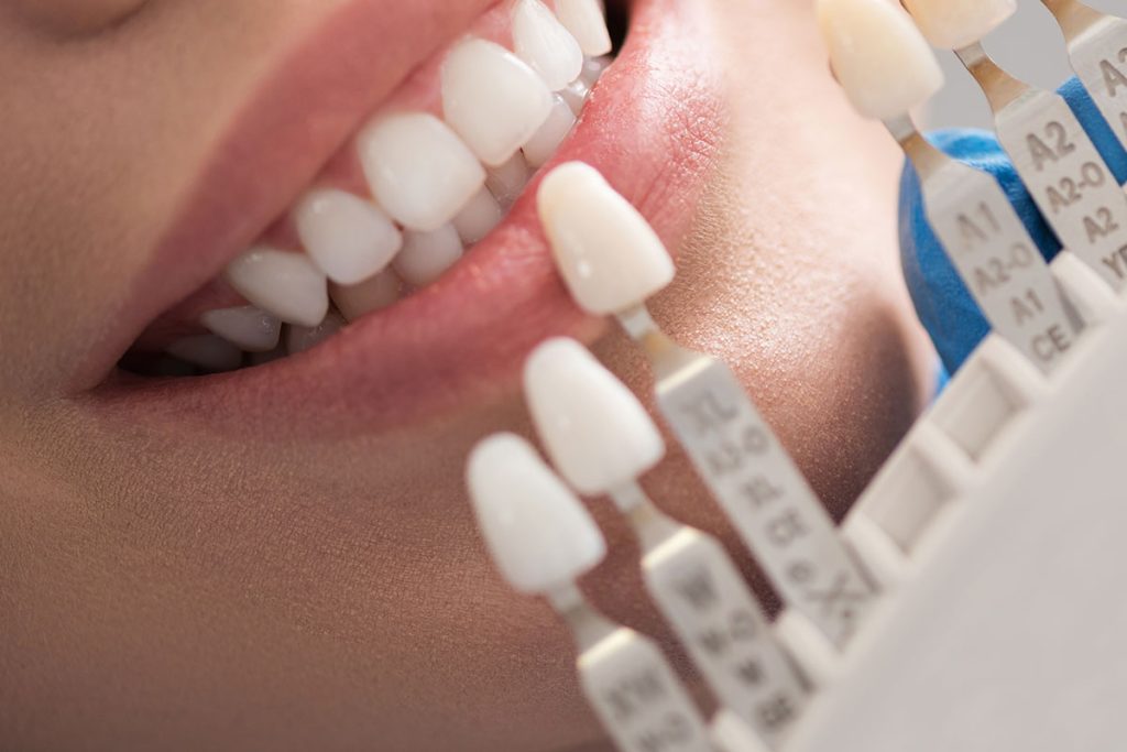 Close-up of a patient’s smile during a dental shade-matching procedure with a color guide.
